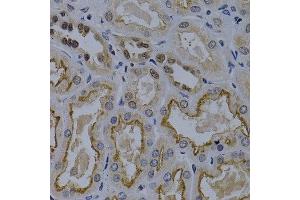 Immunohistochemistry of paraffin-embedded human kidney cancer using TNFRSF6B antibody at dilution of 1:200 (400x lens).
