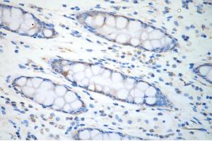 Immunohistochemistry was performed on paraffin-embedded human sigmoid colon carcinoma using acetyl-CoA acetyltransferase 1 antibody (ABIN7797439), 1:200).