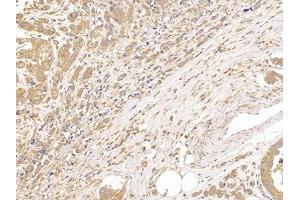 Detection of TUBb in Human Breast cancer Tissue using Polyclonal Antibody to Tubulin Beta (TUBb)