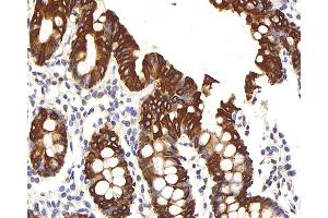 Immunohistochemistry analysis of paraffin-embedded human colon using CK-8 Polyclonal Antibody at dilution of 1:200. (KRT8 anticorps)