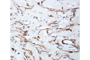IHC-P: VEGF antibody testing of human lung cancer tissue (VEGFA anticorps  (N-Term))