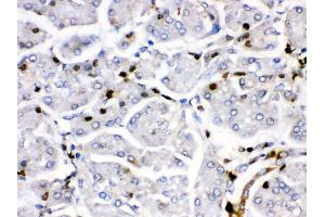 Anti- Fos B antibody, IHC(P) IHC(P): Human Pancreatic Cancer Tissue