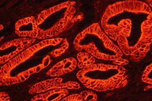 Beta Catenin was detected in paraffin-embedded sections of human intestinal cancer tissues using rabbit anti-Beta Catenin Antigen Affinity purified polyclonal antibody at 1 μg/mL. (Avidin anticorps  (Cy3))