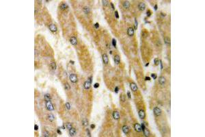Immunohistochemical analysis of ACSL6 staining in human liver cancer formalin fixed paraffin embedded tissue section. (ACSL6 anticorps  (Center))