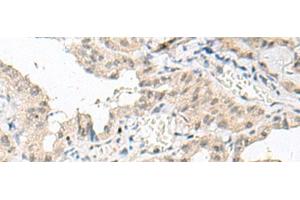 Immunohistochemistry of paraffin-embedded Human thyroid cancer tissue using GFI1B Polyclonal Antibody at dilution of 1:80(x200) (GFI1B anticorps)