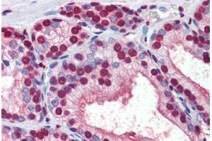 Human Prostate (formalin-fixed, paraffin-embedded) stained with  antibody ABIN462276 followed by biotinylated secondary antibody, alkaline phosphatase-streptavidin and chromogen. (CRABP1 anticorps  (AA 1-137))
