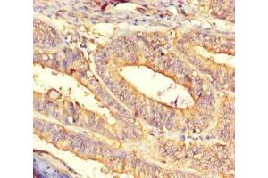 Immunohistochemistry of paraffin-embedded human endometrial cancer using ABIN7149400 at dilution of 1:100 (CNDP2 anticorps  (AA 2-475))
