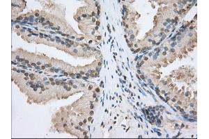 Immunohistochemical staining of paraffin-embedded Adenocarcinoma of Human ovary tissue using anti-SNX9 mouse monoclonal antibody.