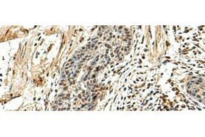 Immunohistochemistry of paraffin-embedded Human esophagus cancer tissue using NUTF2 Polyclonal Antibody at dilution of 1:110(x200) (NUTF2 anticorps)