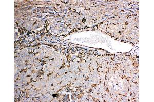 Anti-Gelsolin antibody, IHC(P) IHC(P): Human Lung Cancer Tissue (Gelsolin anticorps  (C-Term))