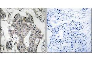 Immunohistochemistry analysis of paraffin-embedded human breast carcinoma tissue, using RAB3GAP2 Antibody. (RAB3GAP2 anticorps  (AA 417-466))