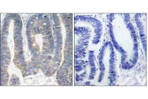 Immunohistochemical analysis of paraffin-embedded human colon carcinoma tissue using PKR (Ab-451) antibody (E021282). (EIF2AK2 anticorps)