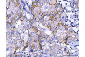 IHC analysis of HER2/ERBB2 using anti-HER2/ERBB2 antibody (ABIN7602717). (ErbB2/Her2 anticorps  (AA 980-1230))