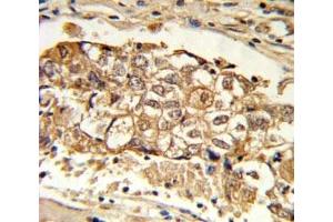 IHC analysis of FFPE human breast carcinoma with MCL1 antibody