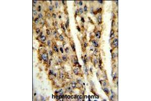Formalin-fixed and paraffin-embedded human hepatocarcinoma reacted with DIO3 Antibody , which was peroxidase-conjugated to the secondary antibody, followed by DAB staining.