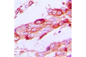 Immunohistochemical analysis of SSBP1 staining in human lung cancer formalin fixed paraffin embedded tissue section.