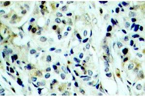Immunohistochemistry of paraffin-embedded Human breast carcinoma using Phospho-HDAC5(S498) Polyclonal Antibody (HDAC5 anticorps  (pSer498))