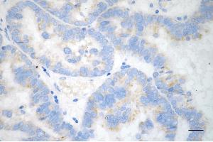 Immunohistochemistry was performed on paraffin-embedded human ovarian carcinoma using taxilin alpha antibody (ABIN7800520), 1:200). (alpha Taxilin anticorps)