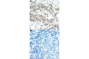 Immunohistochemical staining of human breast cancer tissue by FOXO4 (phospho S197) polyclonal antibody  without blocking peptide (A) or preincubated with blocking peptide (B) under 1:50-1:100 dilution.