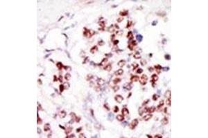 Formalin-fixed and paraffin-embedded human cancer tissue reacted with the primary antibody, which was peroxidase-conjugated to the secondary antibody, followed by DAB staining.