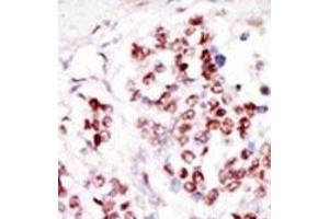 Formalin-fixed and paraffin-embedded human cancer tissue reacted with the primary antibody, which was peroxidase-conjugated to the secondary antibody, followed by DAB staining. (TLK1 anticorps  (C-Term))