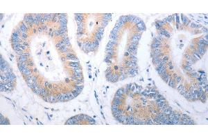 Immunohistochemistry of paraffin-embedded Human colon cancer using PAK1 Polyclonal Antibody at dilution of 1:40