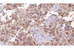 ABIN6273118 at 1/100 staining Human Melanoma tissue by IHC-P. (FSTL1 anticorps  (N-Term))