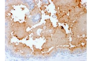 Formalin-fixed, paraffin-embedded human Prostate Carcinoma stained with AMACR Recombinant Mouse Monoclonal Antibody (rAMACR/1864).