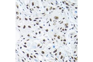 Immunohistochemistry of paraffin-embedded human esophageal cancer using SNRP Rabbit pAb (2161) at dilution of 1:200 (40x lens). (SNRPA1 anticorps  (AA 1-220))