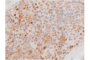 ABIN6267525 at 1/200 staining Human liver cancer tissue sections by IHC-P. (GATA4 anticorps  (pSer262))