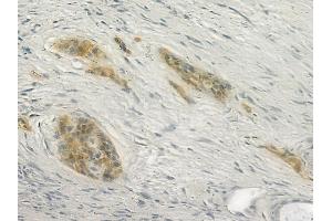 ABIN6266372 and ABIN6277338 at 1/100 staining human pancreatic carcinoma by IHC-P.