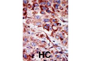Formalin-fixed and paraffin-embedded human hepatocellular carcinoma tissue reacted with AK2 polyclonal antibody  , which was peroxidase-conjugated to the secondary antibody, followed by AEC staining. (Adenylate Kinase 2 anticorps  (C-Term))