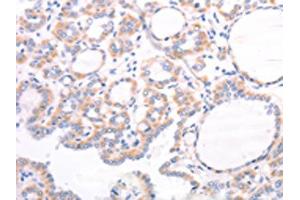 The image on the left is immunohistochemistry of paraffin-embedded Human thyroid cancer tissue using ABIN7131495(TRPC7 Antibody) at dilution 1/25, on the right is treated with fusion protein. (TRPC7 anticorps)