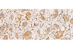 Immunohistochemistry of paraffin-embedded Human liver cancer tissue using RAB38 Polyclonal Antibody at dilution of 1:60(x200) (RAB38 anticorps)