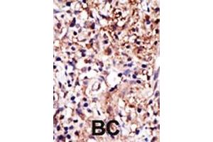 Formalin-fixed and paraffin-embedded human cancer tissue reacted with the primary antibody, which was peroxidase-conjugated to the secondary antibody, followed by DAB staining.