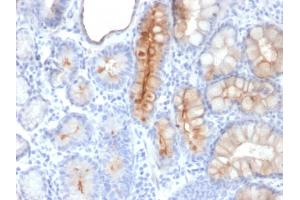 Formalin-fixed, paraffin-embedded human Gastric Carcinoma stained with MUC4 Mouse Monoclonal Antibody (MUC4/3084).