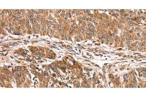 Immunohistochemistry of paraffin-embedded Human lung cancer using PDLIM4 Polyclonal Antibody at dilution of 1:30 (PDLIM4 anticorps)