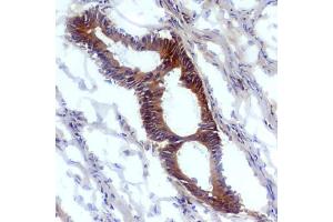 Immunohistochemistry staining (frozen sections) of human tumoral colon epithelium with anti-nitrotyrosine antibody (EM-30).