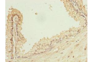 Immunohistochemistry of paraffin-embedded human prostate cancer using ABIN7163733 at dilution of 1:100