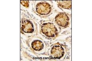 Formalin-fixed and paraffin-embedded human colon carcinoma reacted with PDGFRL antibody (C-term) (ABIN392037 and ABIN2841805) , which was peroxidase-conjugated to the secondary antibody, followed by DAB staining. (PDGFRL anticorps  (C-Term))