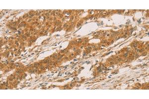 Immunohistochemistry of paraffin-embedded Human gastric cancer tissue using SLC6A3 Polyclonal Antibody at dilution 1:50 (SLC6A3 anticorps)
