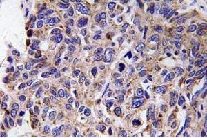 Immunohistochemistry (IHC) analyzes of MMP-12 antibody in paraffin-embedded human lung carcinoma tissue. (MMP12 anticorps)