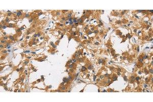 Immunohistochemistry of paraffin-embedded Human thyroid cancer tissue using DUSP23 Polyclonal Antibody at dilution 1:30 (DUSP23 anticorps)