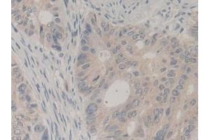 Detection of UBA52 in Human Colorectal cancer Tissue using Polyclonal Antibody to Ubiquitin A 52 Residue Ribosomal Protein Fusion Product 1 (UBA52)