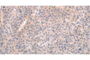 Immunohistochemistry of paraffin-embedded Human liver cancer tissue using ABCF1 Polyclonal Antibody at dilution 1:40 (ABCF1 anticorps)