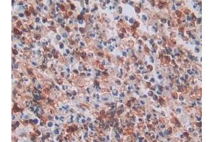 Detection of NB1 in Human Colorectal cancer Tissue using Polyclonal Antibody to Neutrophil Specific Antigen 1 (NB1)