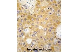 Formalin-fixed and paraffin-embedded human hepatocarcinoma tissue reacted with H1 antibody (N-term) 6302a , which was peroxidase-conjugated to the secondary antibody, followed by DAB staining. (APH1A anticorps  (N-Term))