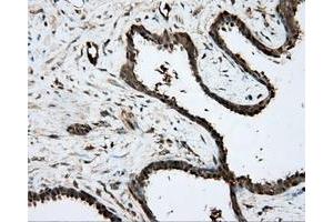 Immunohistochemical staining of paraffin-embedded Carcinoma of prostate tissue using anti-PRKAR2A mouse monoclonal antibody. (PRKAR2A anticorps)