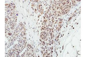IHC-P Image Immunohistochemical analysis of paraffin-embedded SW480 xenograft, using MPP3, antibody at 1:500 dilution. (MPP3 anticorps  (Center))