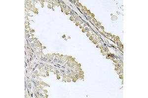 Immunohistochemistry of paraffin-embedded human prostate using CDH5 antibody at dilution of 1:100 (x40 lens). (Cadherin 5 anticorps)
